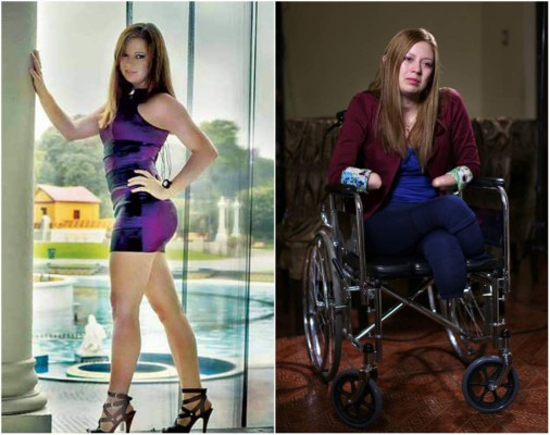 'Todos se lavan las manos': Universitaria que le amputaron pies y manos