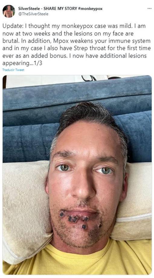 De acuerdo con el Centros para el Control y Prevención de Enfermedades (CDC, por sus siglas en inglés), la viruela símica “es una enfermedad rara” que “rara vez es mortal”, aunque no por ello deja de ser alarmante.