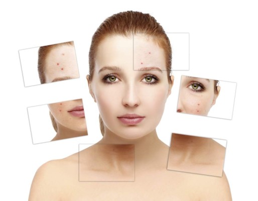 El acné aparece a cualquier edad