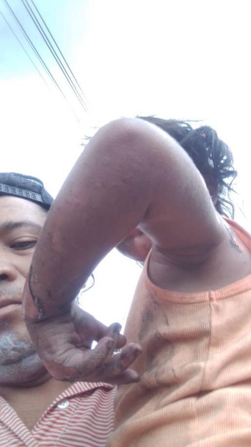 Otra de su niña identificada como Andrea Mejía Santos de 4 años fue rescatada por un vecino en el incendio y fue llevada por su papá al Catarino Rivas para ser atendida por las fuertes quemaduras que sufrió en su cuerpo.