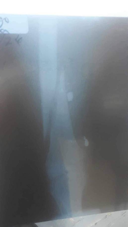 La bala provocó que el fémur de la pierna izquierda del joven jugador se partiera en dos.