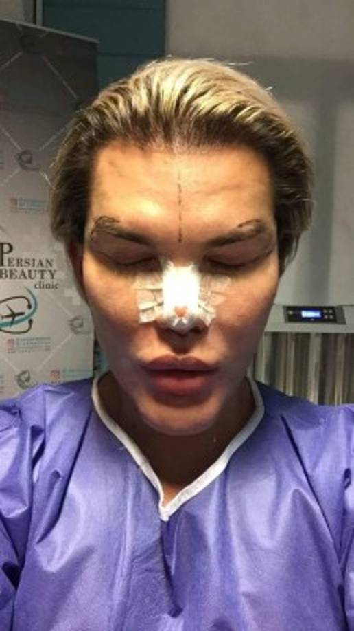 Su primera cirugía se la hizo a los 17 años, y desde entonces ha pasado por un quirófano un total de 58 veces. Según ha dicho a través de su cuenta de Instagram, no piensa detenerse, pues gracias a los bullies halló fuerza para cambiar su vida y su apariencia, para convertirse en una