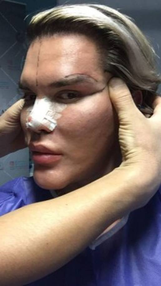 El brasileño se ha sometido a liposucciones, implantes en el abdomen y rellenos de botox en el rostro, entre otros muchos procedimientos. También ha viajado por todo el mundo para hallar a los mejores cirujanos plásticos, para levantar sus ojos y modificar la forma de su rostro.