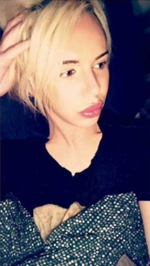 Bryan se ha sometido al relleno de labios y la corrección de algunas cirugías en su nariz.