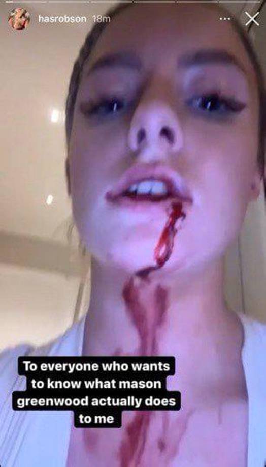 En esta imagen se puede ver como sangra profusamente y dice en la propia ‘story’ lo siguiente: “Para que todos sepan lo que realmente me ha hecho Mason Greenwood”.
