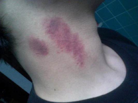 Muere mexicano por un 'beso' de su novia