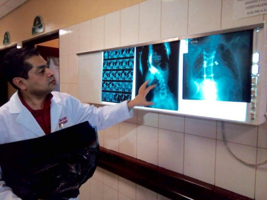 Realizan primera cirugía para enderezar columna en Tegucigalpa