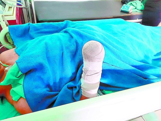 Potente cohete le cercena mano a policía