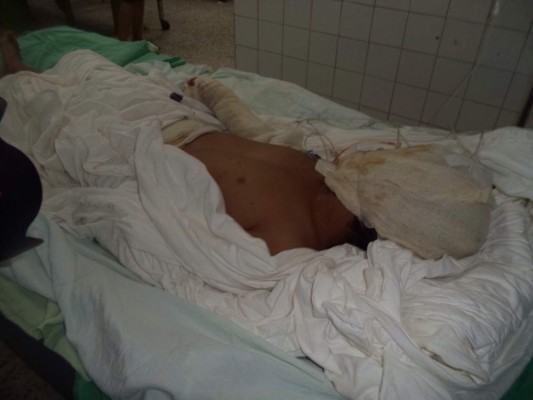 Niño hondureño quemado por pólvora viaja a Estados Unidos por cirugía