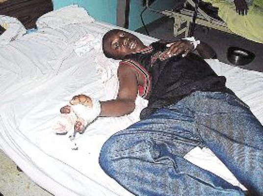 Dos quemados por pólvora en hospital de Puerto Cortés