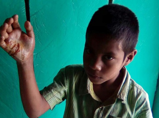 Padrastro, a la cárcel por quemarle la mano a niño