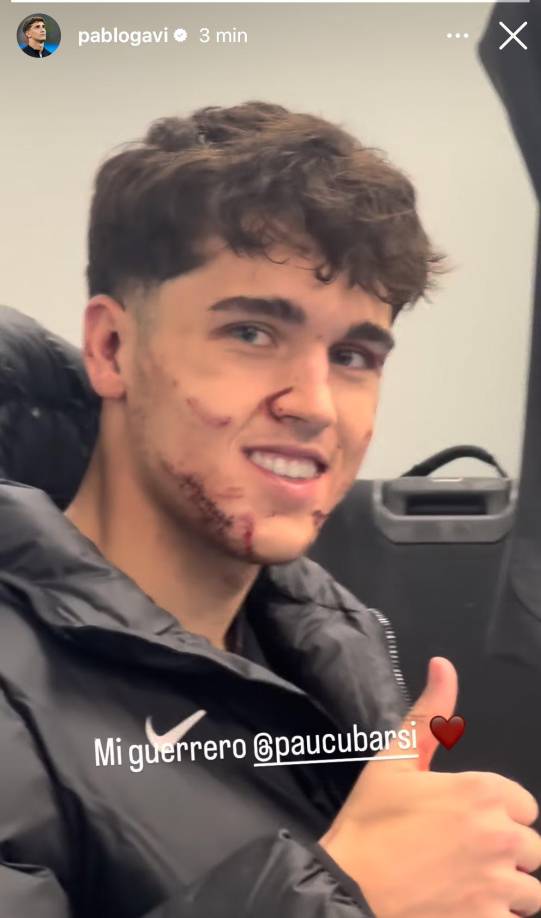 Gavi también compartió las imágenes del futbolista con la terrible herida que sufrió en Champions League.