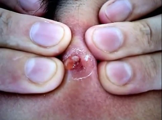 Joven se extirpa espinilla que tuvo por más de 20 años