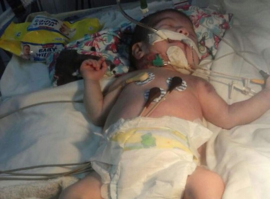 Bebé sufre graves quemaduras en hospital hondureño