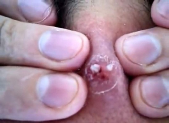 Joven se extirpa espinilla que tuvo por más de 20 años