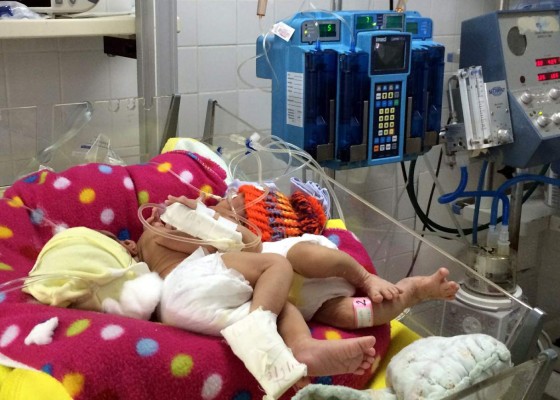 Aún no hay apoyo para trasladar al exterior a siamesas hondureñas