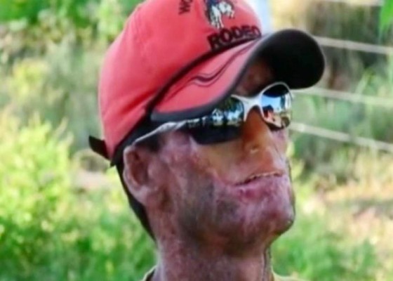 Rara enfermedad derrite la piel de pobladores en Brasil