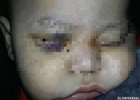 Extirpan el ojo equivocado a un bebé que sufre cáncer