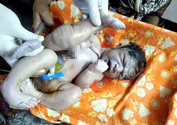 Nace bebé con cuatro piernas y tres manos e intentan matarlo