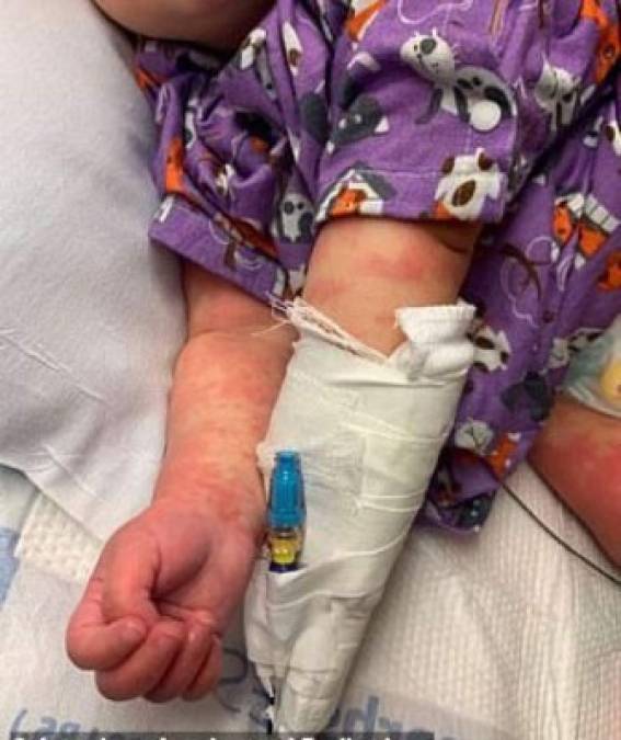 La bebé, identificada como Zara, fue ingresada en el Hospital de Niños Lucile Packard en Palo Alto, donde recibió tratamiento para la enfermedad de Kawasaki y se recupera rápidamente.