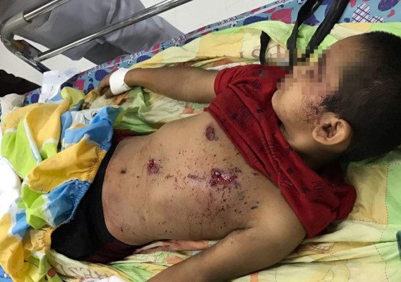 Niño pierde la mano izquierda al explotarle mortero
