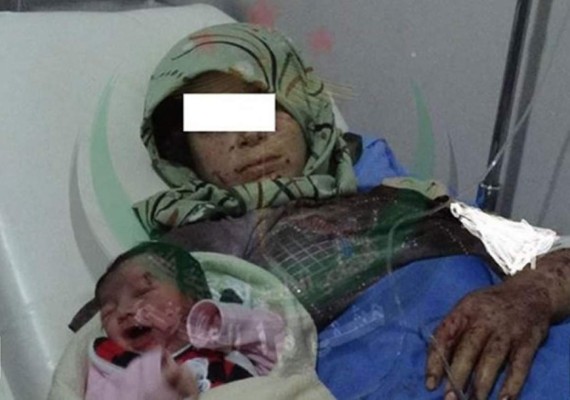 Bebé siria nace con metralla en la cabeza