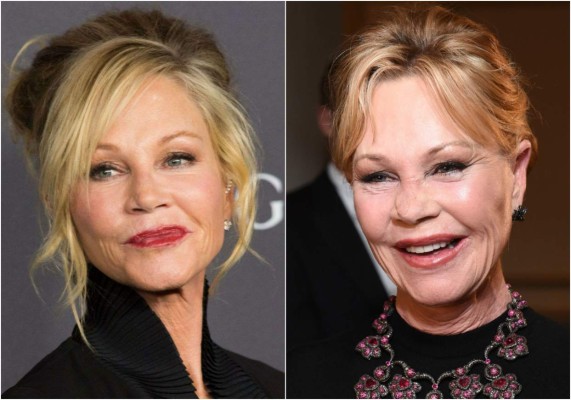 Melanie Griffith luce irreconocible tras operación por cáncer de piel