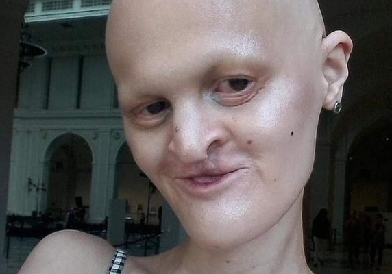 La modelo Melanie Gaydos padece un raro tipo de displasia ectodérmica que le hace tener un aspecto único.