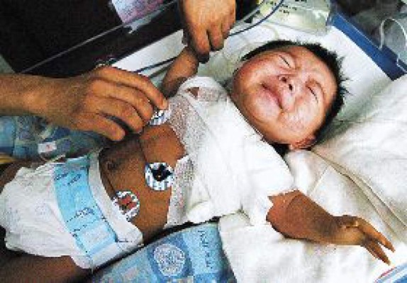 Operan a niño que nació con 3 brazos