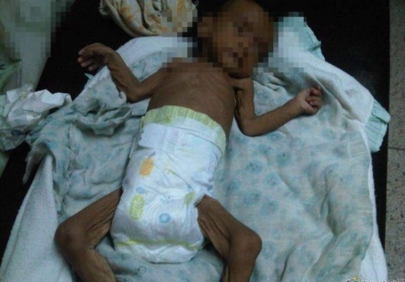Venezuela: Niños no reciben comida en hospital y se alimentan por donaciones