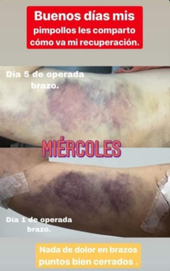 Alejandra Rubio tuvo un periodo de recuperación con masajes moldeadores y terapia física. En un proceso que ella catalogó como doloroso pero satisfactorio.