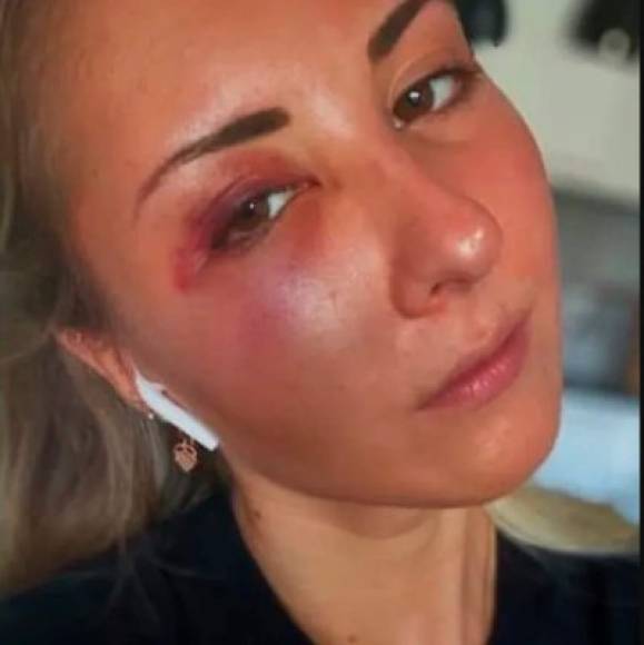 Una foto de la cara magullada de Elisabeth publicada en la cuenta de Twitter de France Bleu Alsace se hizo viral y provocó la furia de cientos de usuarios.<br/><br/>