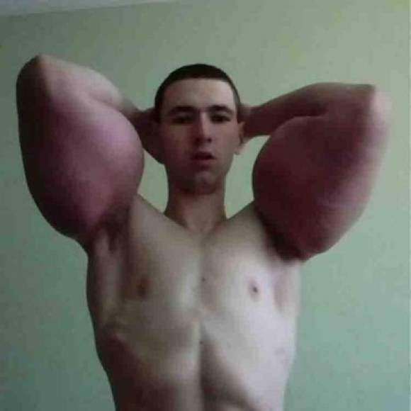 Kirill Tereshin, se hizo famoso en las redes sociales, tras inyectarse una sustancia Synthol en sus brazos, los mismos que alcanzaron un gran tamaño.