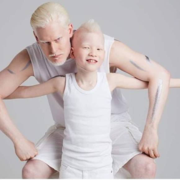 Stephen Thompson ha posado para las mejores marcas de ropas y fragancias, ha sido usado para campañas de la ONU con el objetivo de realizar a los albinos.