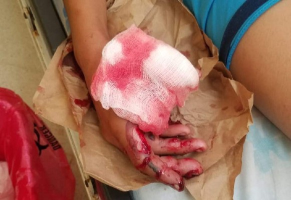 Suman 46 menores quemados con pólvora en Honduras
