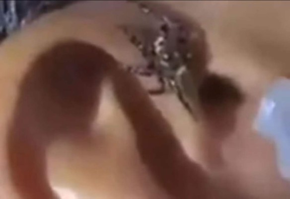 El horrible momento cuando una araña sale de un oído  