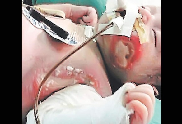 Bebé sufre graves quemaduras en hospital hondureño
