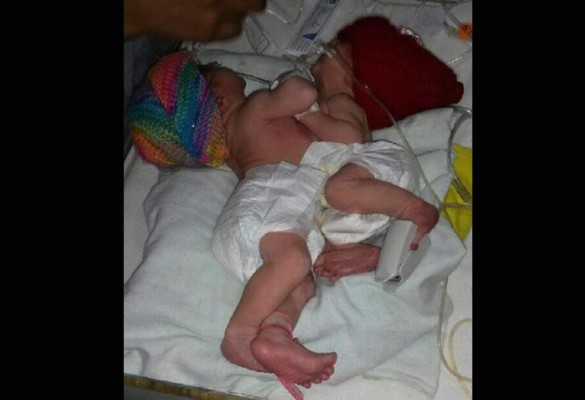 Madre de siamesas no sabía que tenía un embarazo gemelar