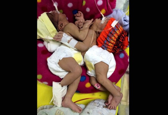 Siamesas sampedranas ya toleran leche materna