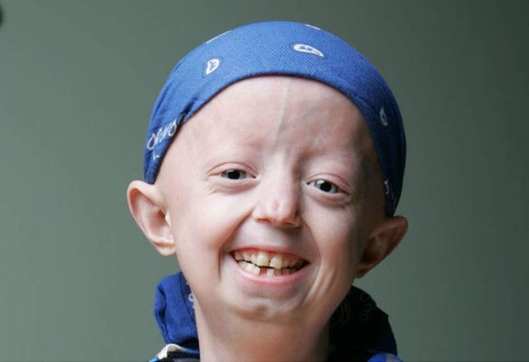 Muere Hayley Okines, la adolescente más vieja del mundo