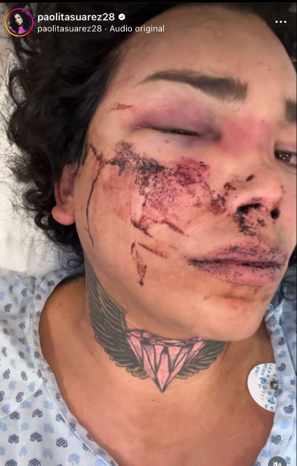 “Estuve vomitando coágulos de sangre”, expresó Paola Suárez en el live que hizo Wendy Guevara. En esa misma transmisión en vivo se compartió que las amigas de Suárez estaban decidiendo si la movían a un hospital particular, ante ello, “Las Pérdidas” le ofrecieron su apoyo y le dijeron que no se preocupara por lo económico y que entre todas hacían “una vaquita”.