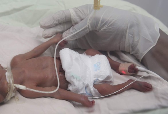 Bebé hondureño se aferra a la vida; su peso es de media libra