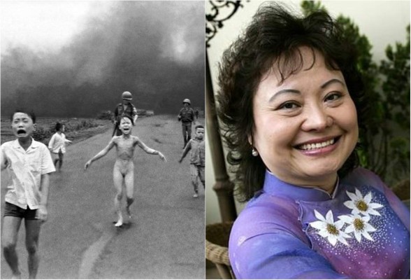 'La niña del napalm' recibe tratamiento 43 años después de la guerra de Vietnam
