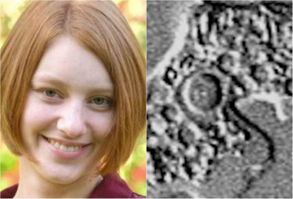 Joven muere a causa de una ameba 'comecerebros' en EUA