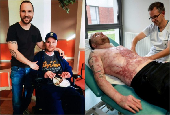 Un quemado casi integral sobrevive gracias al trasplante de la piel de su gemelo