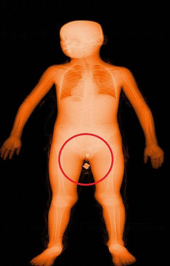 Para sorpresa de la seguridad del penal, la máquina bodyscam detectó que el pequeño llevaba en su área genital un extraño objeto, que posiblemente se trataría de drogas.
