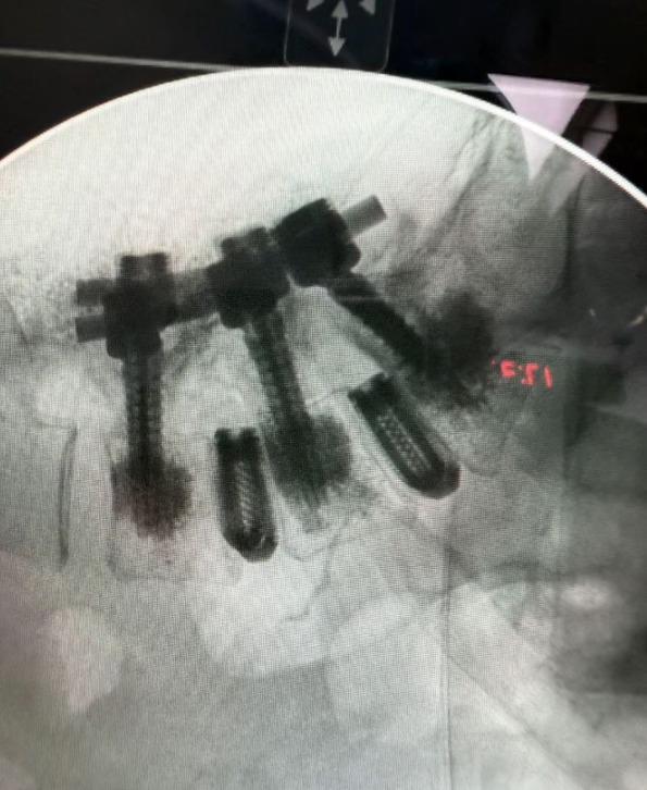 Alejandra Guzmán es operada de la columna vertebral, ¿cuál es su estado de salud?