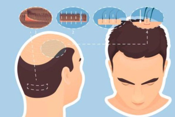 Trasplante capilar en Honduras: 9 cosas que debes saber