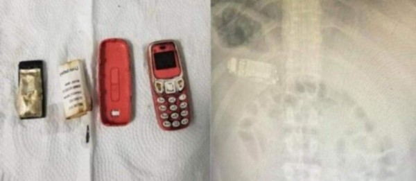 Equipo médico extrae un teléfono móvil del estómago de un preso