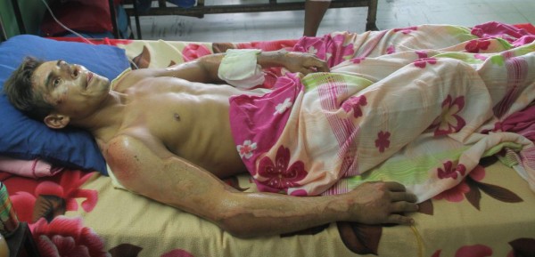 Adán necesita medicamentos para recuperarse de las quemaduras